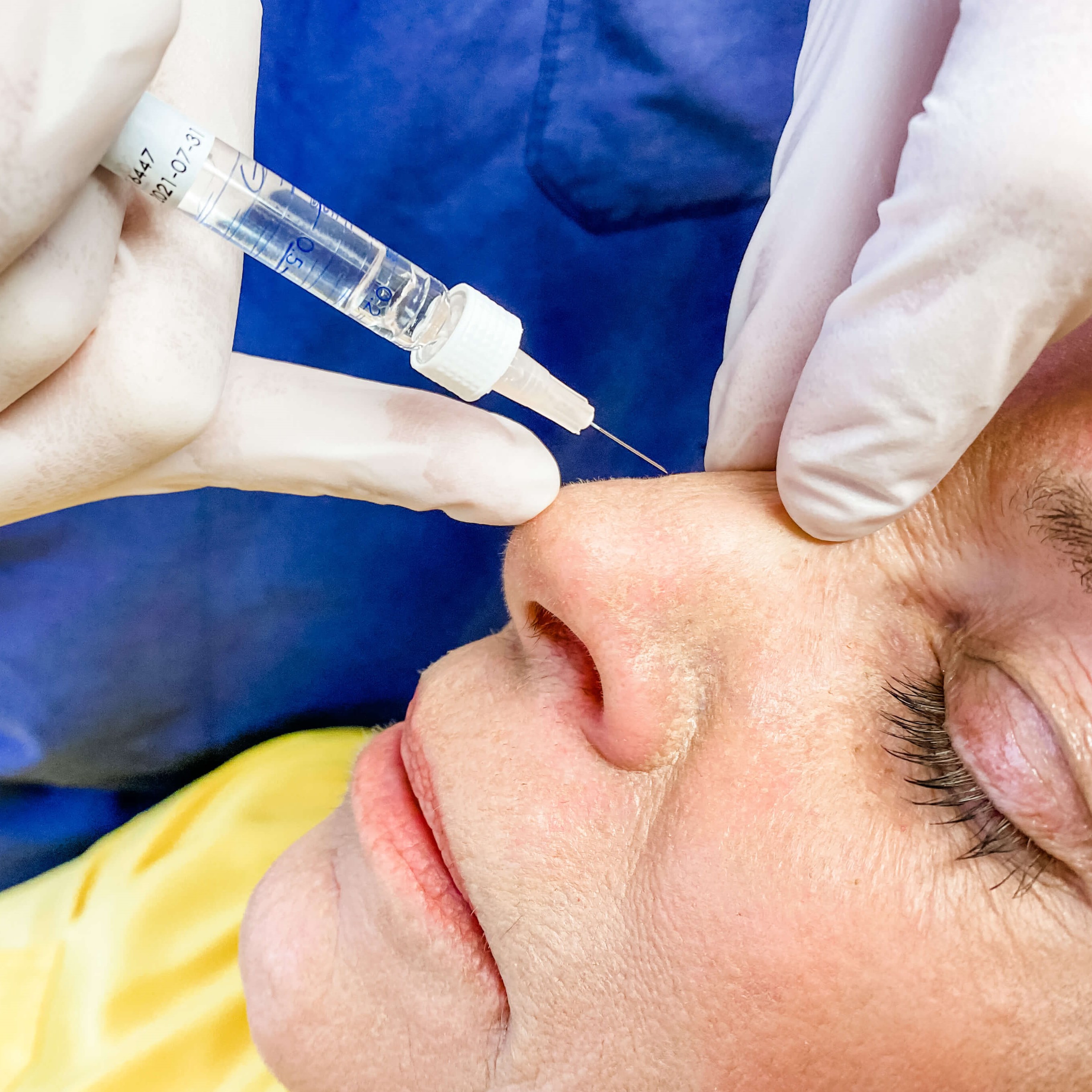 liquid rhinoplasty